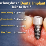how long does an implant take to heal
